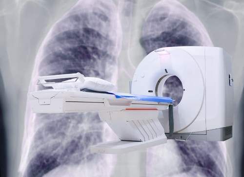 CTと肺の画像