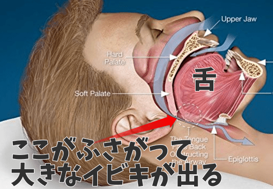 閉塞性睡眠時無呼吸症候群の治療