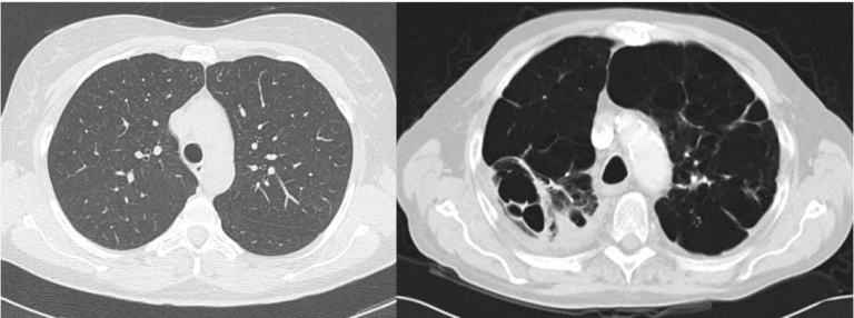  COPDと肺気腫の症状